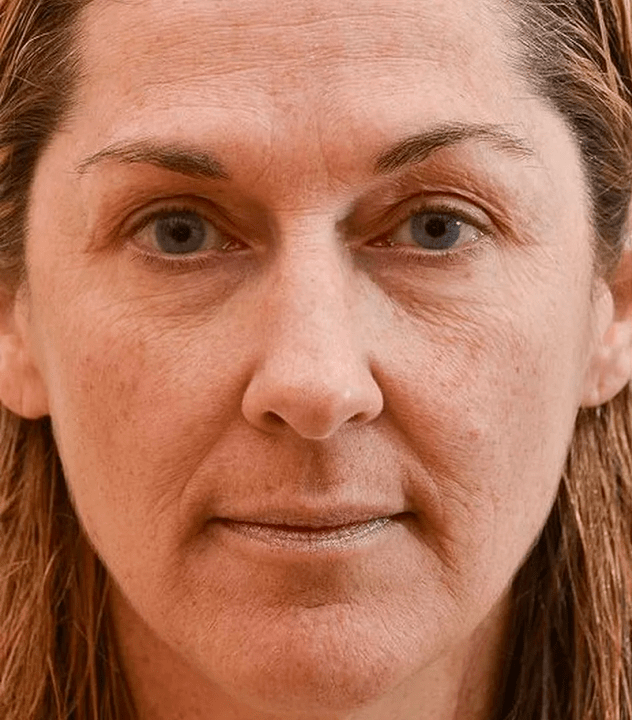 Minu nägu enne Eudalie kreemi kasutamist