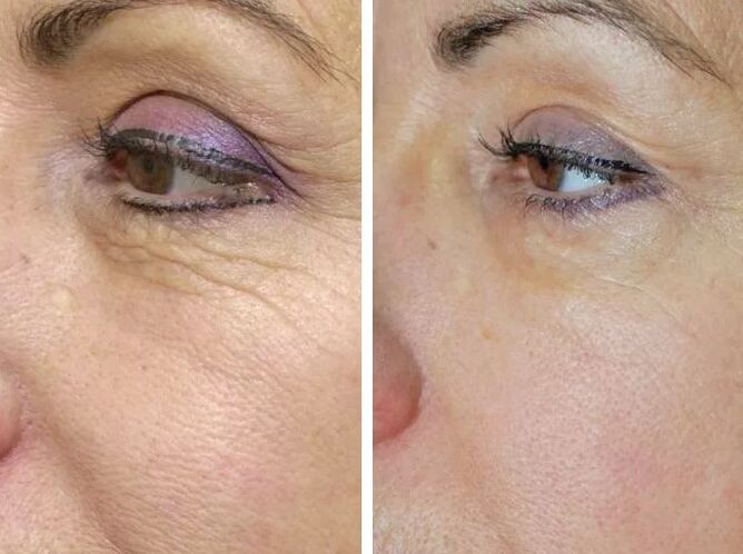 Põllulaser enne ja pärast